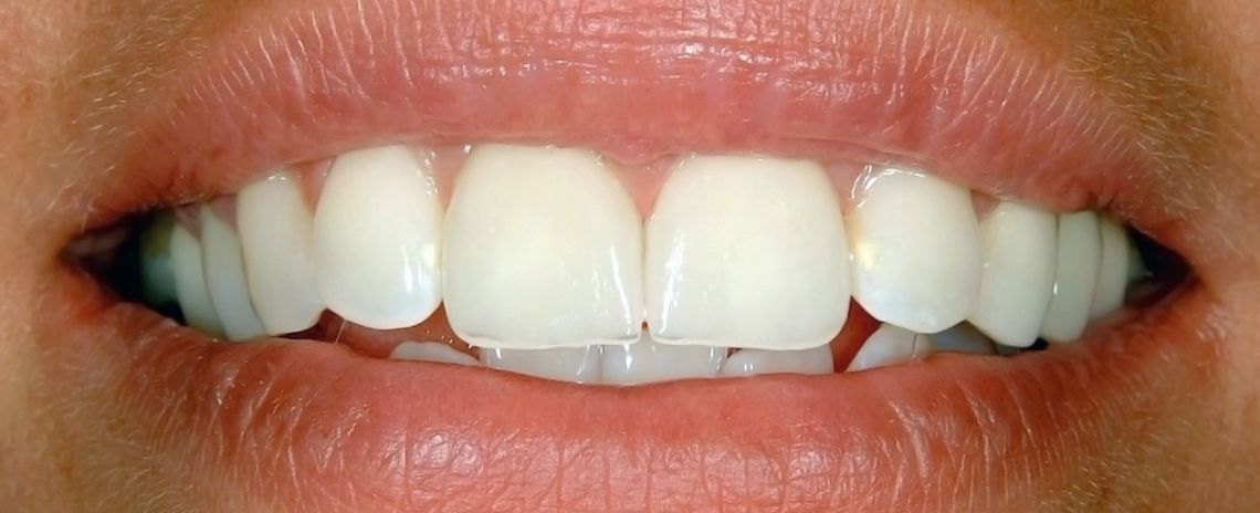 Crown After