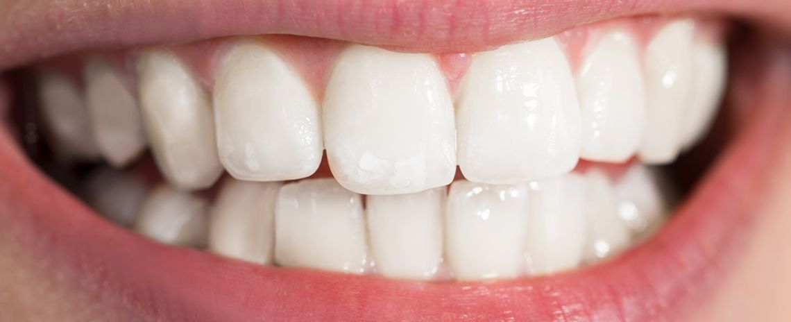 Teeth Whitening After