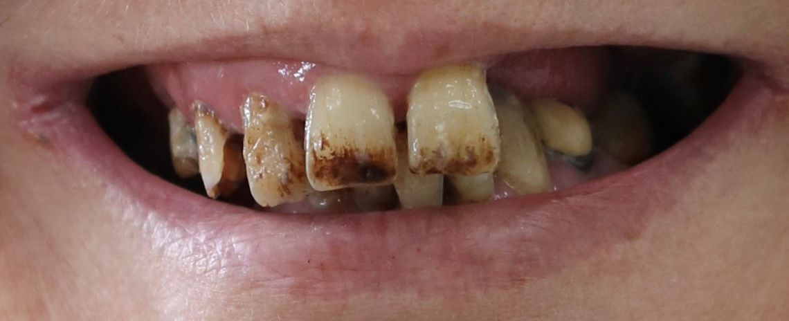 Dentures 1 Dentures Before