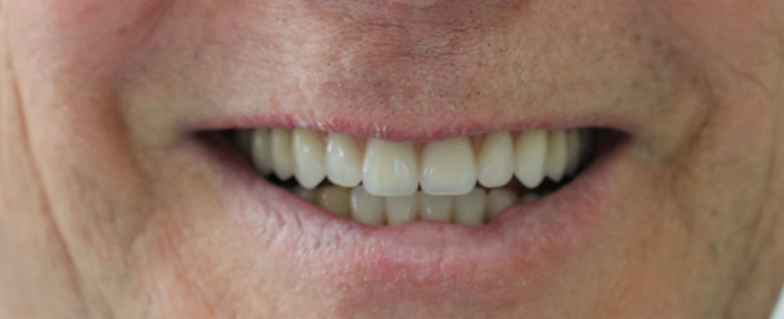 Dentures 3 Dentures After