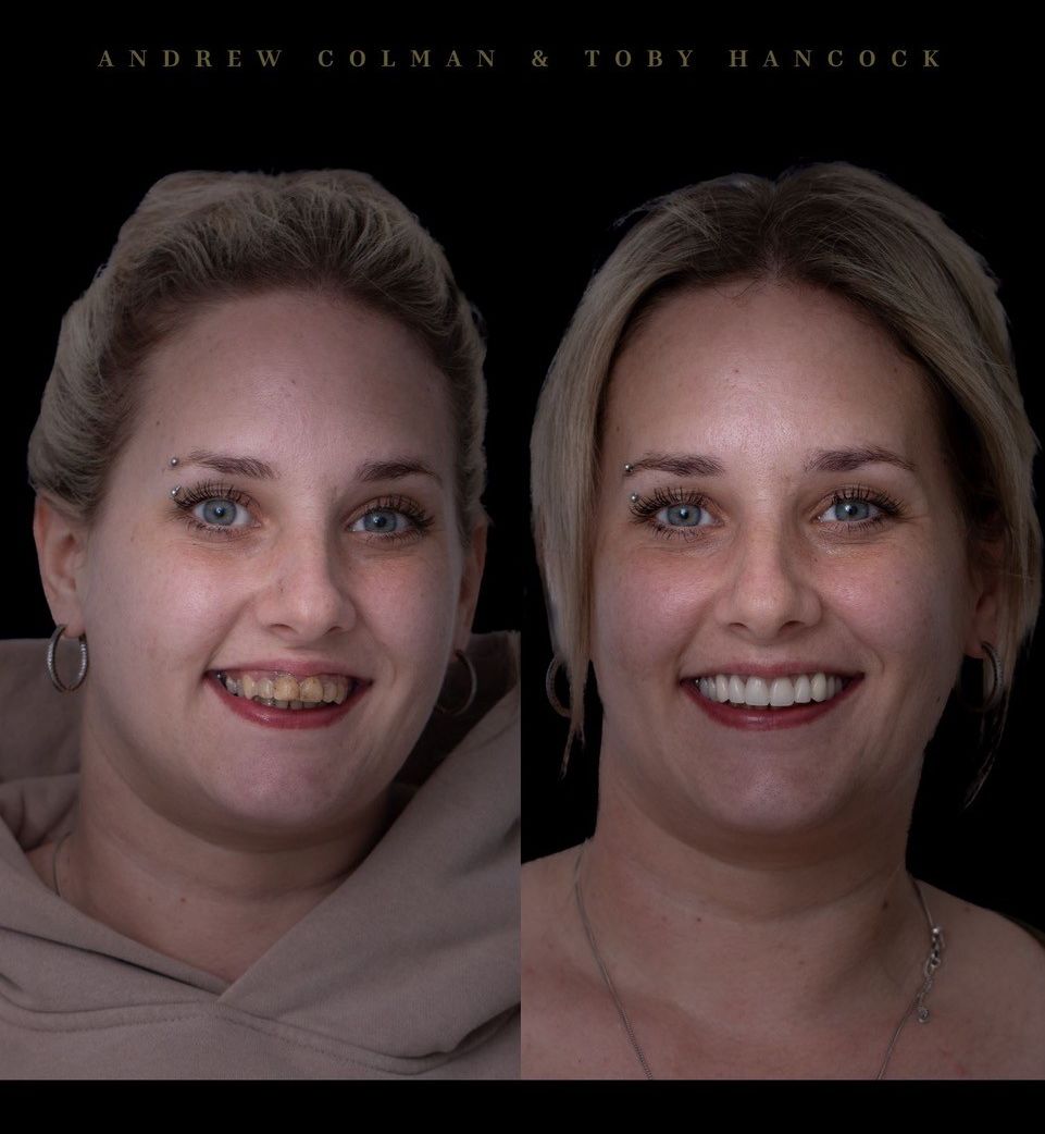 Designer Dentures Open Week