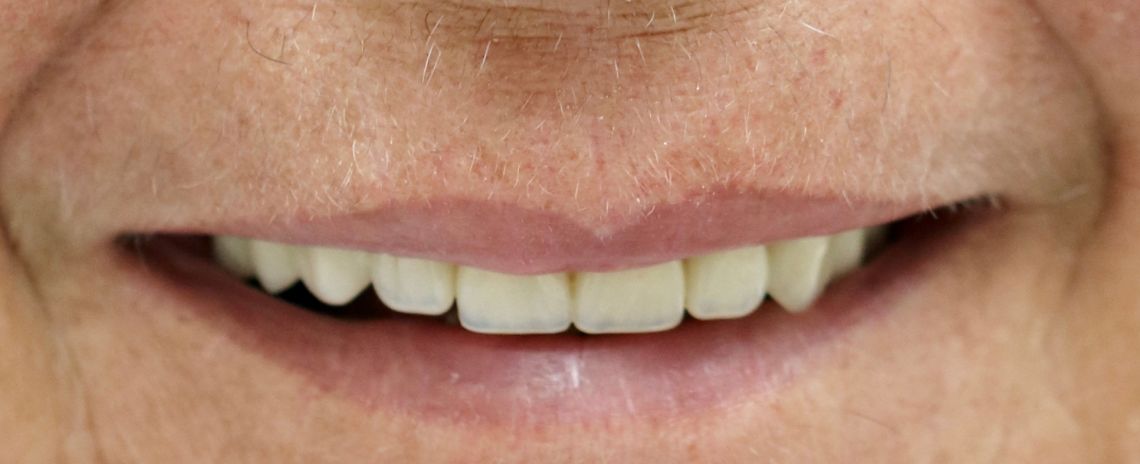 Dentures 2 Dentures After