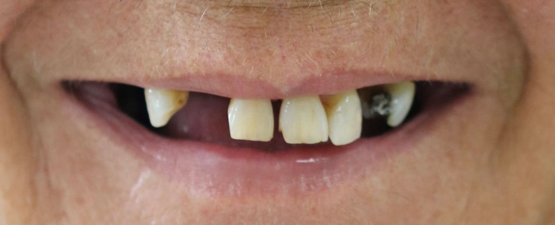 Dentures 2 Dentures Before