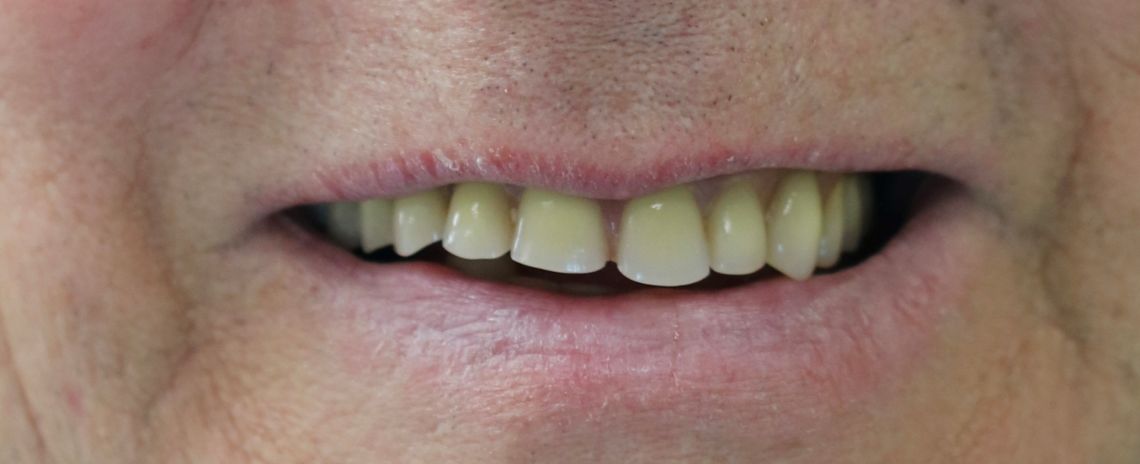 Dentures 3 Dentures Before